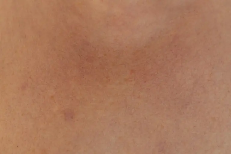 a close up of a person's back with acne on it