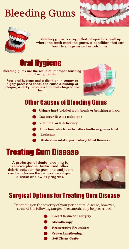 Top Reasons for Bleeding Of Gums